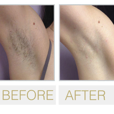 Best San Francisco Laser Hair Removal Doctor Near Me ...