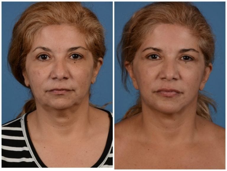 Blepharoplasty Eyelid Surgery San Francisco Bay Area 