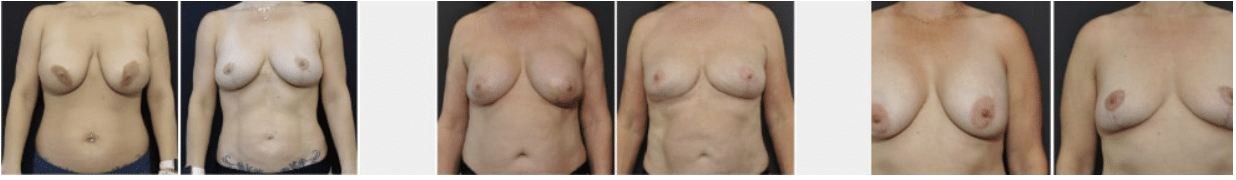 breast implant removal and lift cost