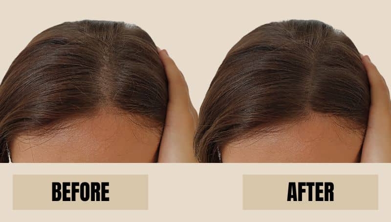 hair transplant before and after women